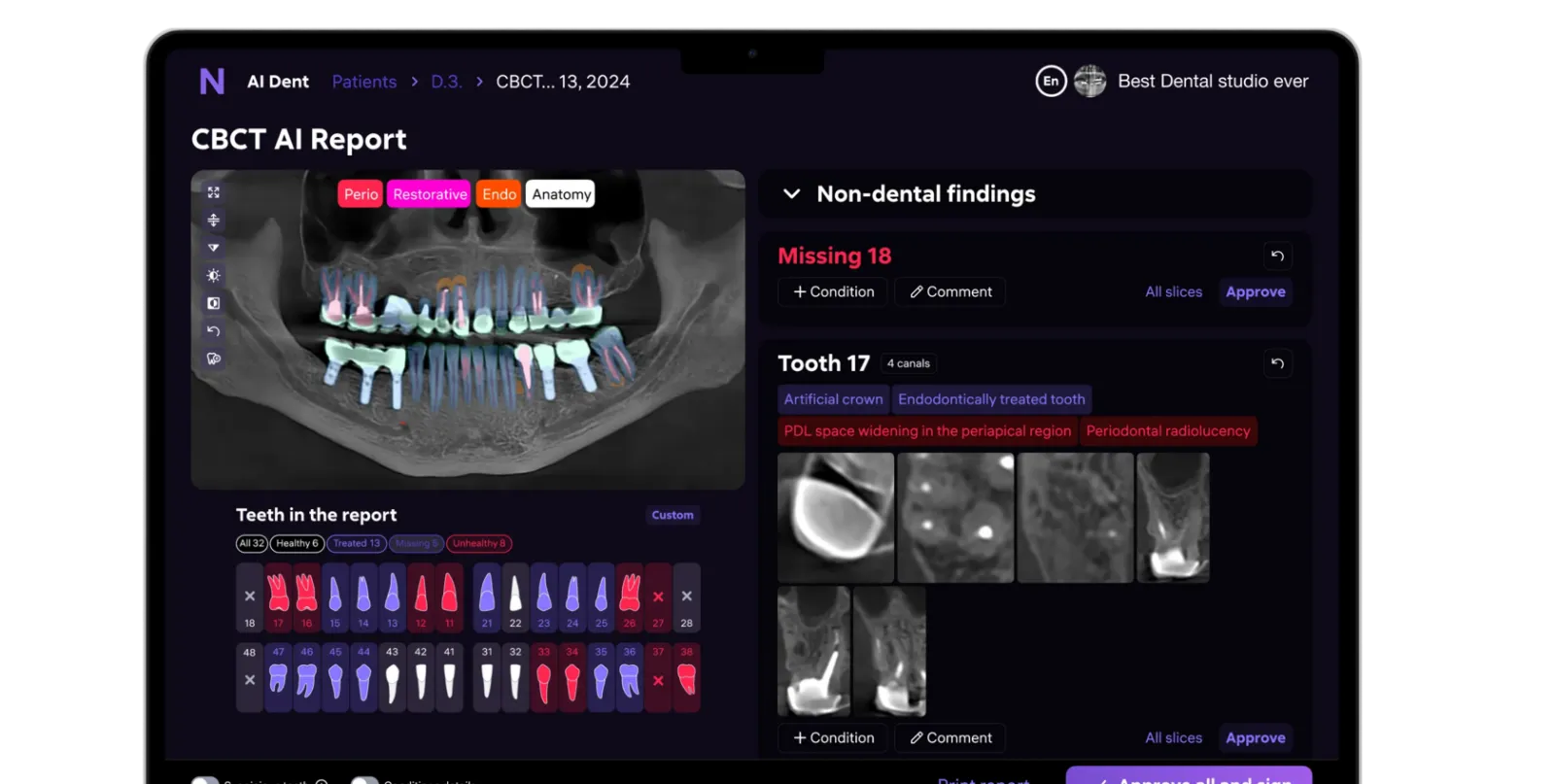 3D-отчёт AI Dent по КЛКТ — ИИ-разметка, панель находок, карточки состояния зубов