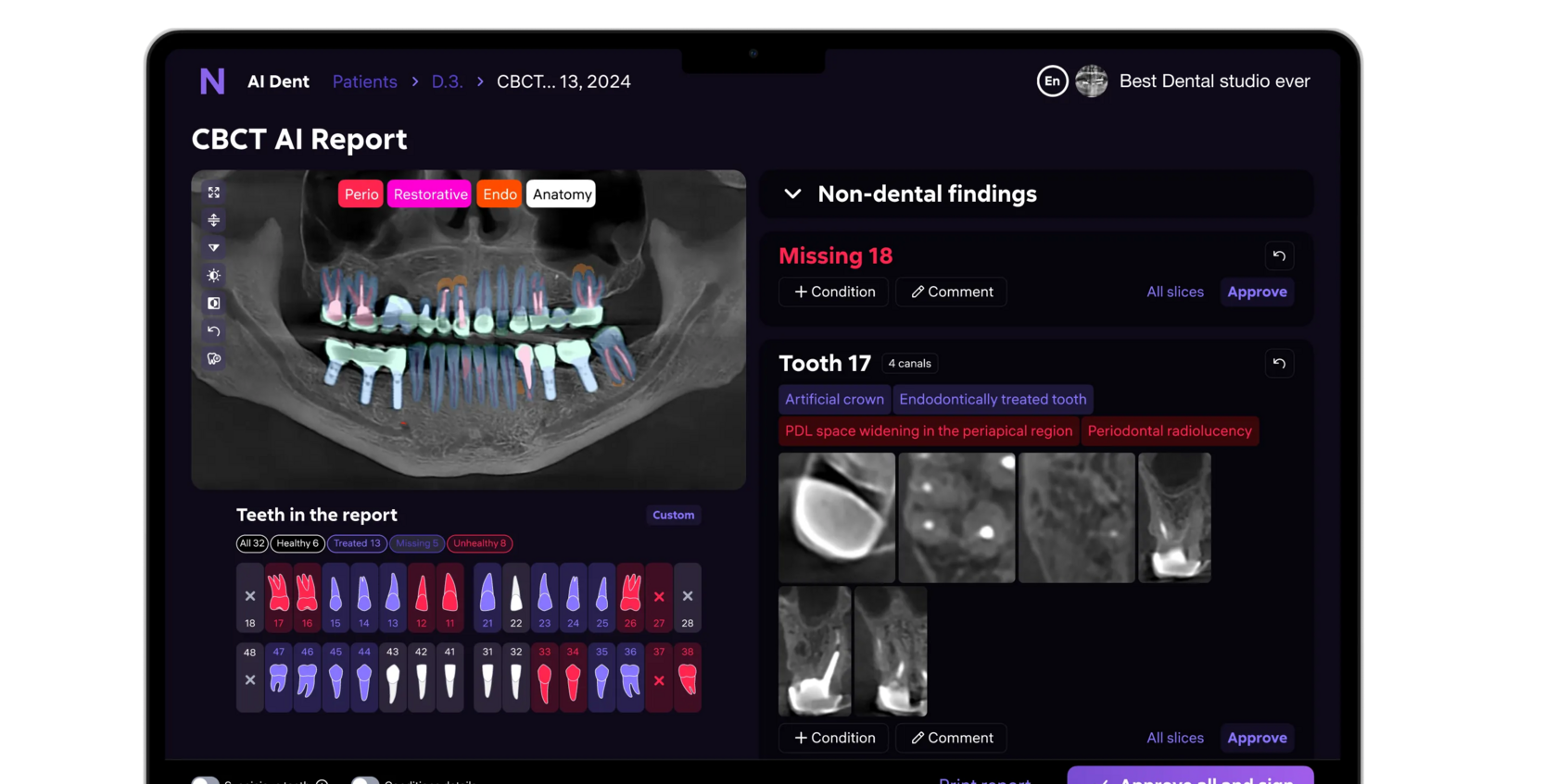 AI Dent CBCT 3D report — AI overlay annotations, findings panel, tooth condition cards