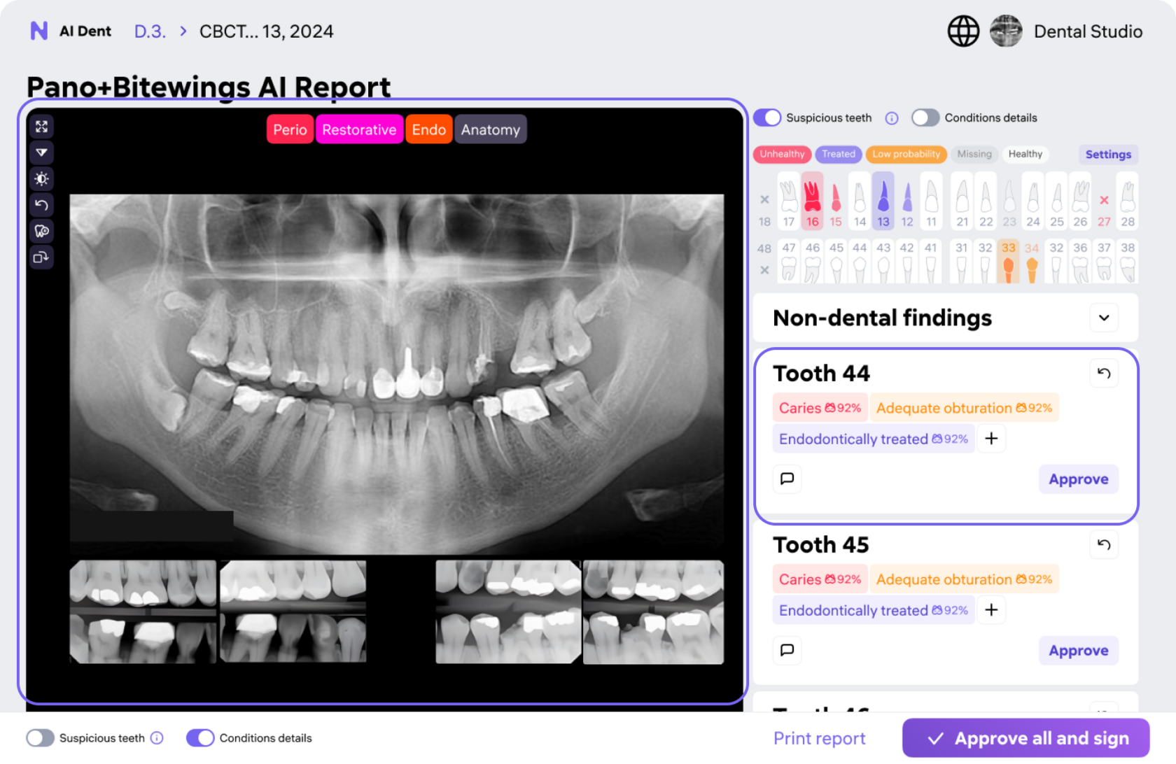 AI Dent radiology report — panoramic X-ray with AI overlay findings
